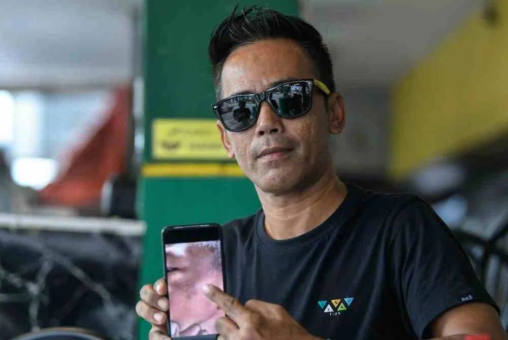 Syamsul Azrin menunjukkan kesan lebam pada bahagian muka anak lelakinya yang menjadi mangsa buli pelajar senior di sekolah.