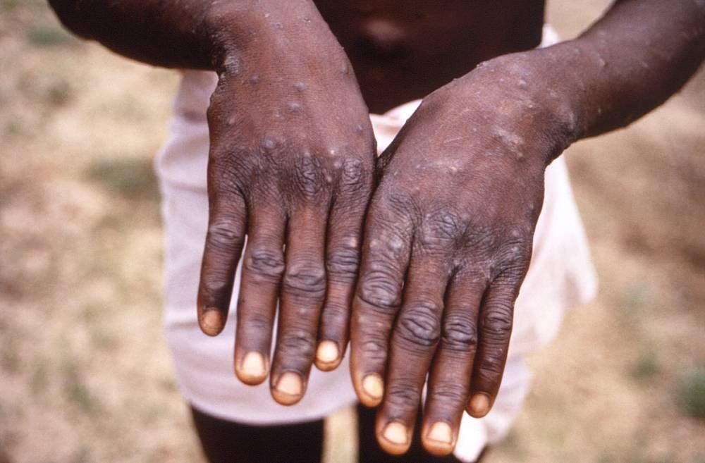 This handout photo provided by the Centres for Disease Control and Prevention was taken in 1997 during an investigation into an outbreak of monkeypox, which took place in the Democratic Republic of the Congo. - AFP