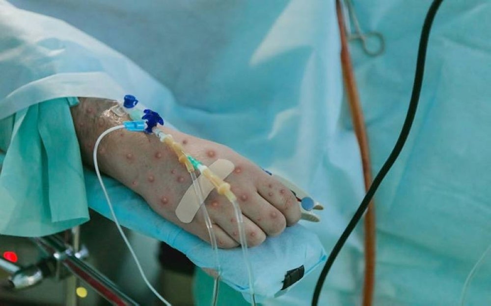 The patient tested positive for monkeypox on July 6, 2022 and is currently warded at the National Centre for Infectious Diseases. Illustration photo: 123RF