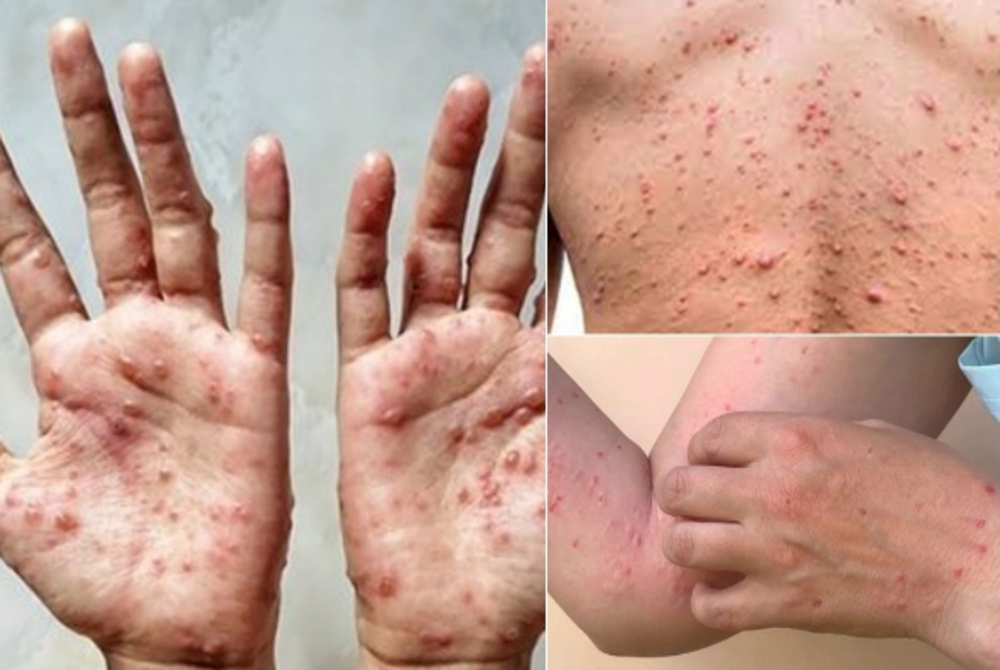 Residents in the state are advised to seek immediate treatment at the nearest clinic or hospital if they have monkeypox-like (mpox) symptoms. - BERNAMA