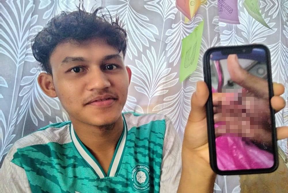 Ahmad Fathul shows the injuries sustained during the incident. 