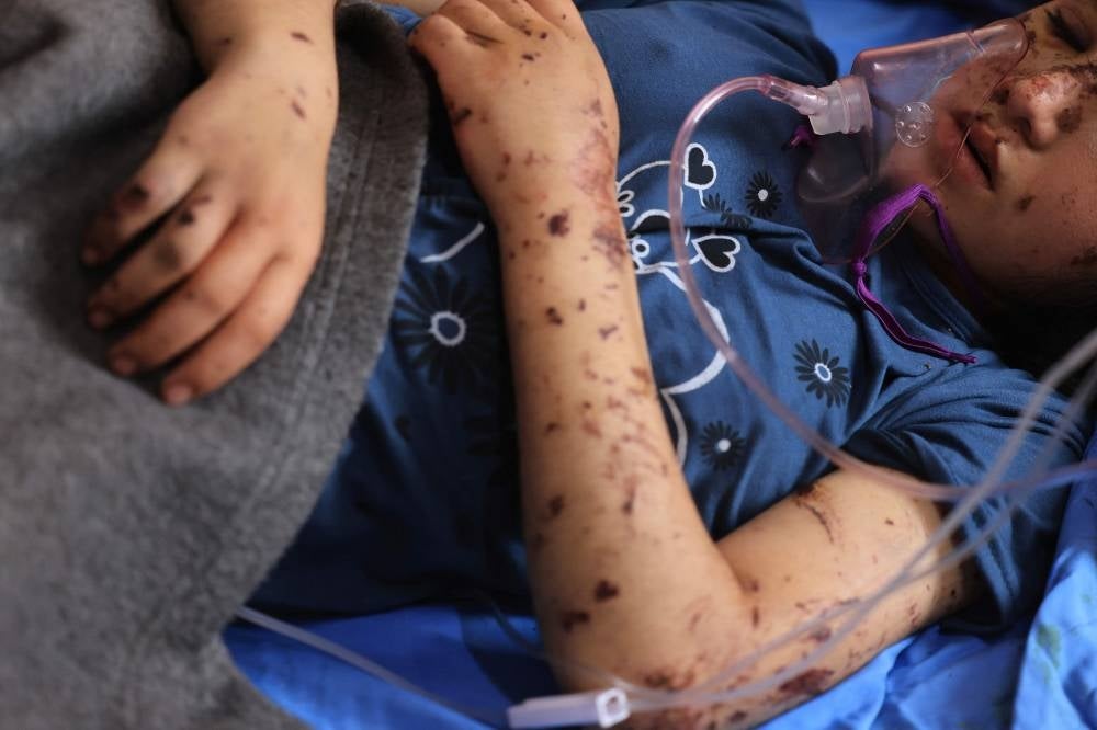 Thirteen year-old amputee Layan al-Baz receives treatment at the Nasser hospital in Khan Yunis in the southern Gaza Strip on Oct 31. - Photo by AFP