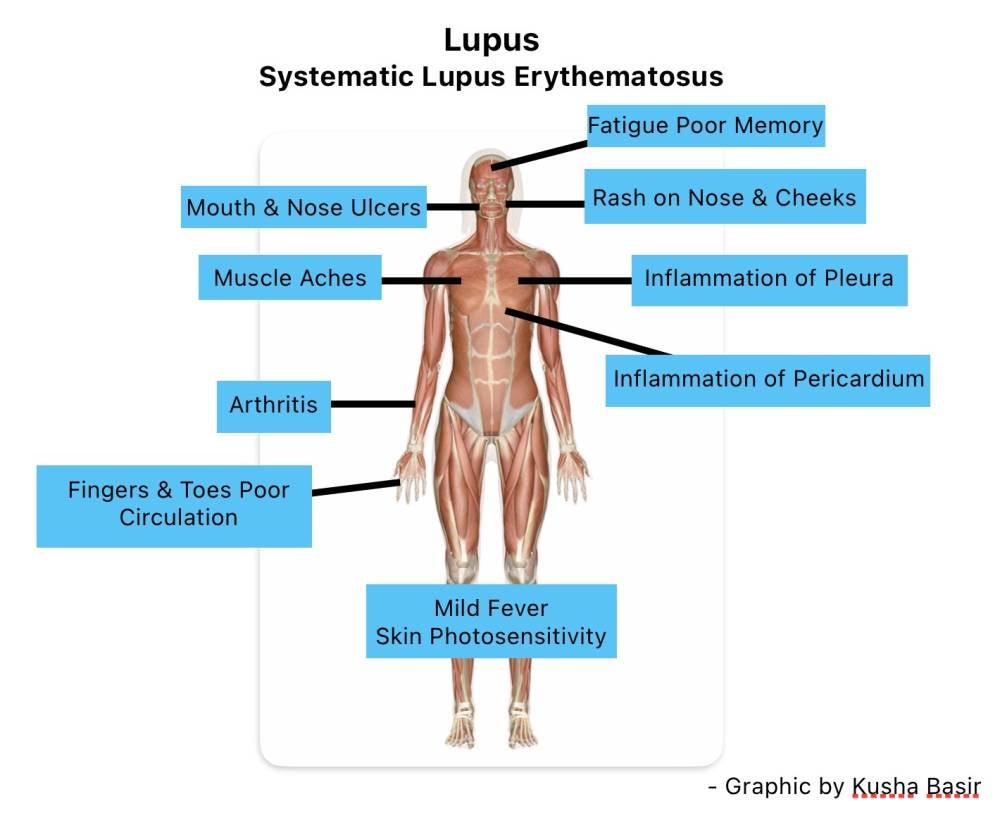 Over 90 per cent of lupus patients are females. - Infographic by Bernama