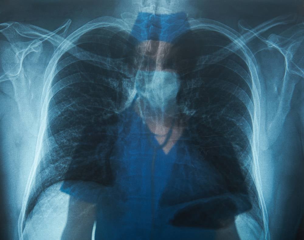 Malaysia has shown an uptrend in tuberculosis cases over the last three years. Photo - 123RF
