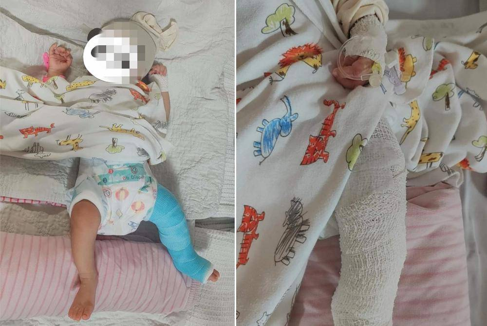 A two-month-old baby girl suffered a broken left leg, suspected to have been abused by a babysitter in an incident in Bandar Dato’ Onn, Johor Bahru.