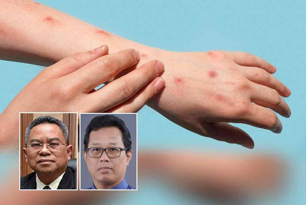 Although mpox is not as dangerous as Covid-19, the public is advised to remain vigilant against the risk of infection. Photo by National Institute For Communicable Diseases, inset from left: Dr Zainal, Dr Wan Mohd Zahiruddin.