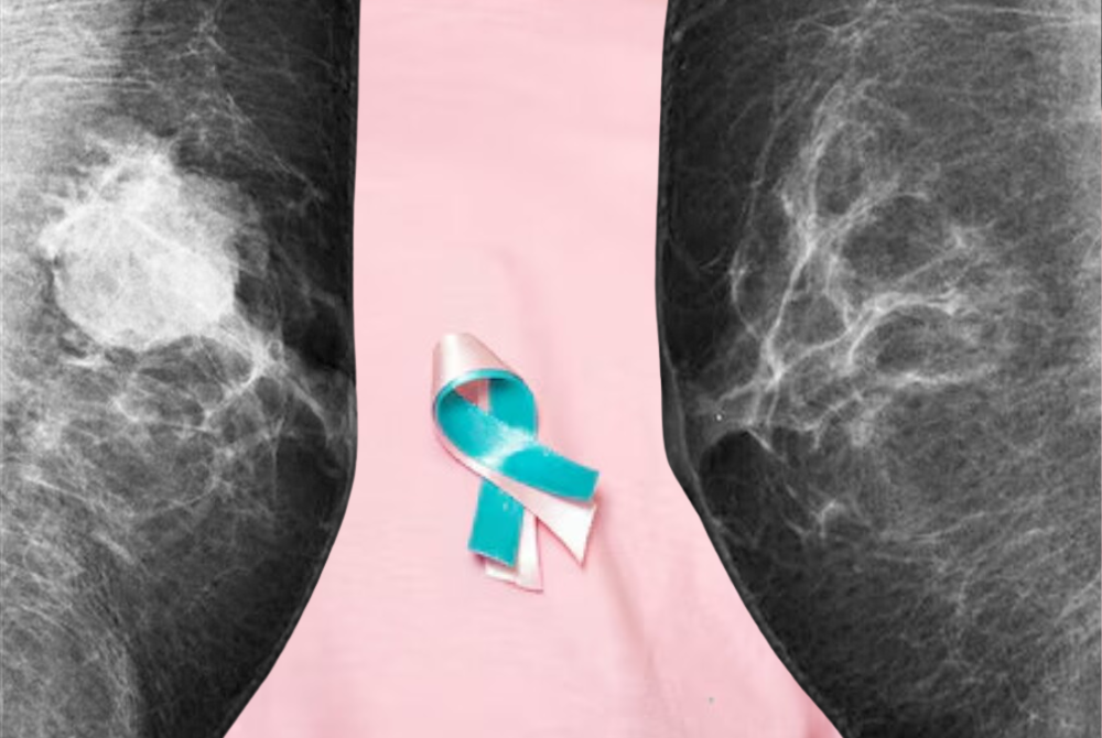 Yes, men can get breast cancer too. 