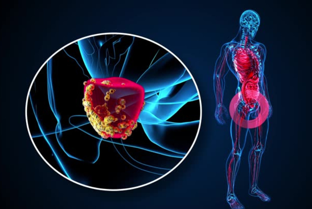 Prostate cancer cases in Malaysia are gradually increasing, now ranking as the third most common cancer among men, with a reported incidence of nine cases per 100,000 population based on the National Cancer Registry (2017–2021).
Photo source: Free stock images 