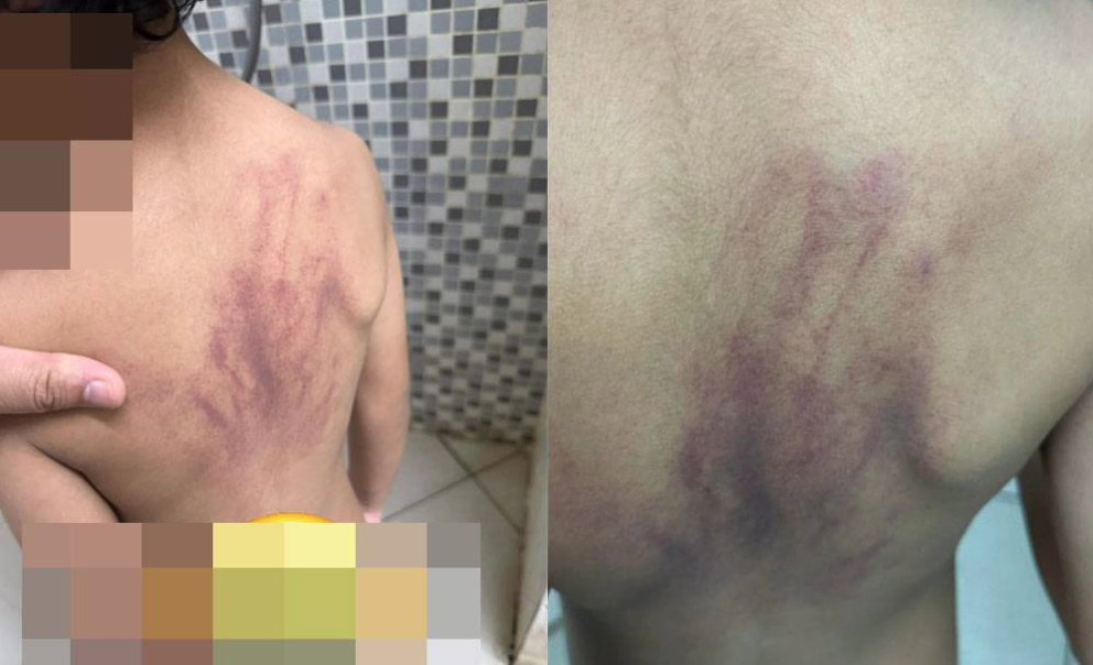 Bruises on the back of an autistic child, allegedly abused at daycare. Photo: Nazmi's Facebook account