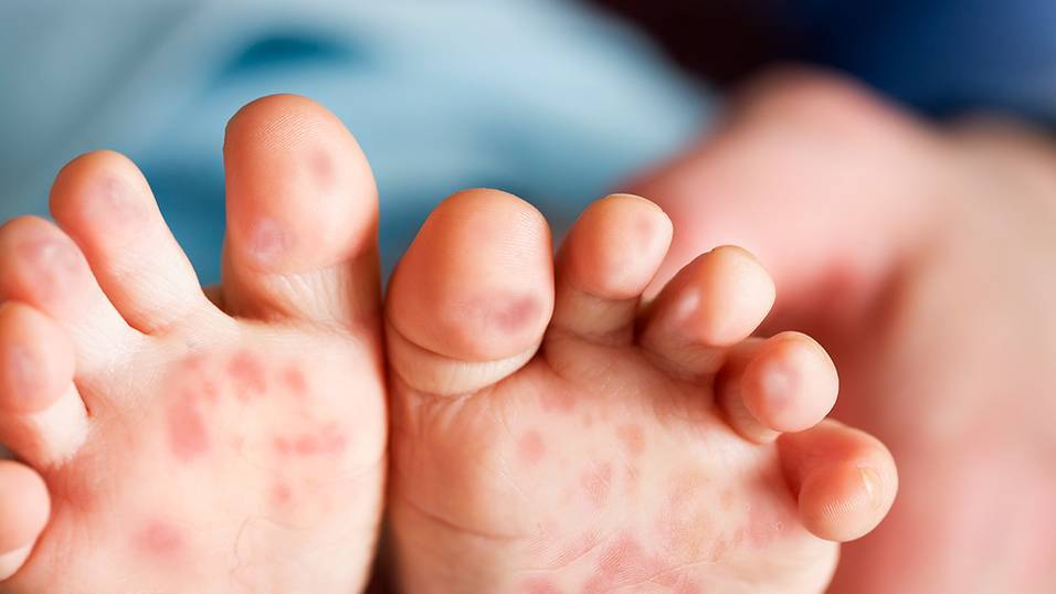 Penang recorded a significant increase in Hand, Foot and Mouth Disease (HFMD) cases in the first three months of this year, with 3,446 cases reported from Jan 1 to March 22. Photo for illustrative purposes only.