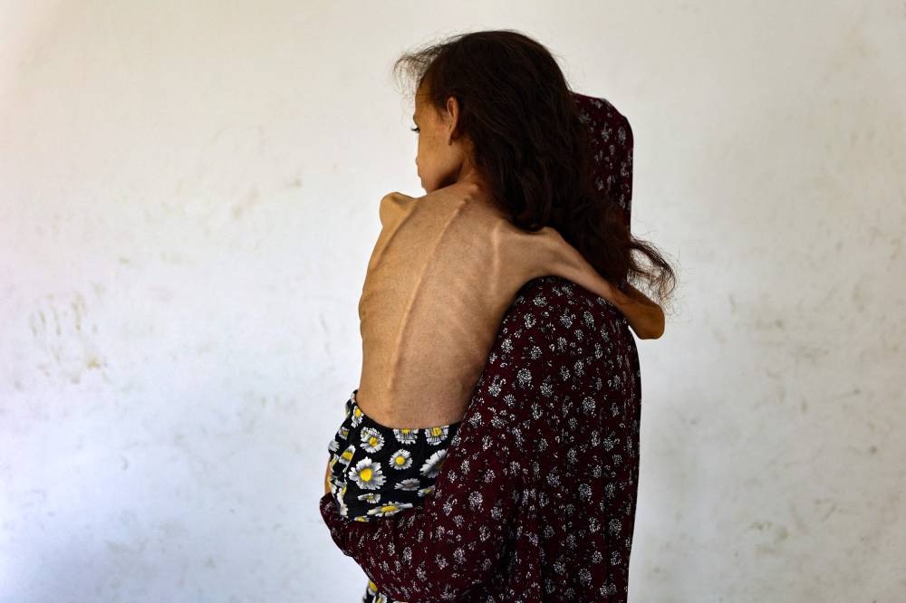 Nine-year-old malnourished Palestinian girl Mariam Dawwas is carried by her mother in the Rimal neighbourhood in Gaza City on August 2, 2025. The World Health Organisation warned on July 27 that malnutrition was reaching