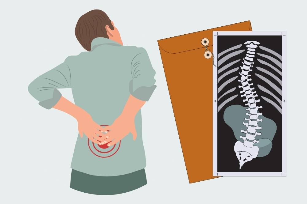 Scoliosis may begin as a slight slouch or curve, but for those living with it, it often means enduring breathlessness, discomfort, emotional strain and quiet resilience. Photo: Edited via Canva
