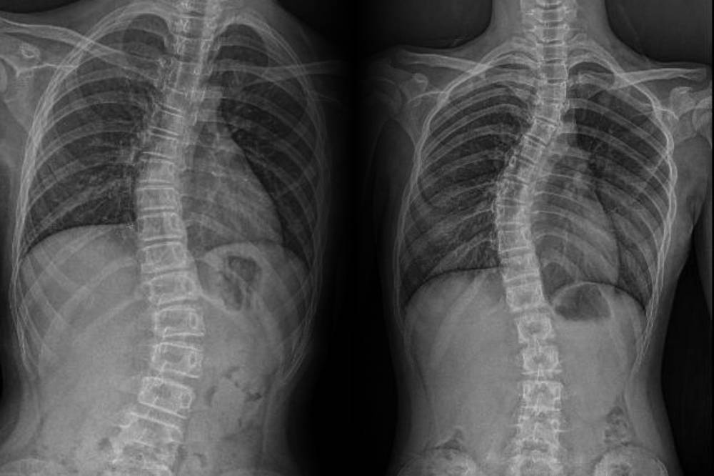 Scoliosis may begin as a slight slouch or curve, but for those living with it, it often means enduring breathlessness, discomfort, emotional strain and quiet resilience. Photo: Edited via Canva
