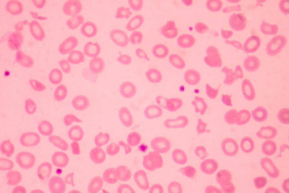 Thalassemia is a hereditary blood disorder that impairs the body’s ability to produce enough haemoglobin, the protein in red blood cells responsible for transporting oxygen, due to a genetic mutation affecting its production. Photo for illustrative purposes only - Canva