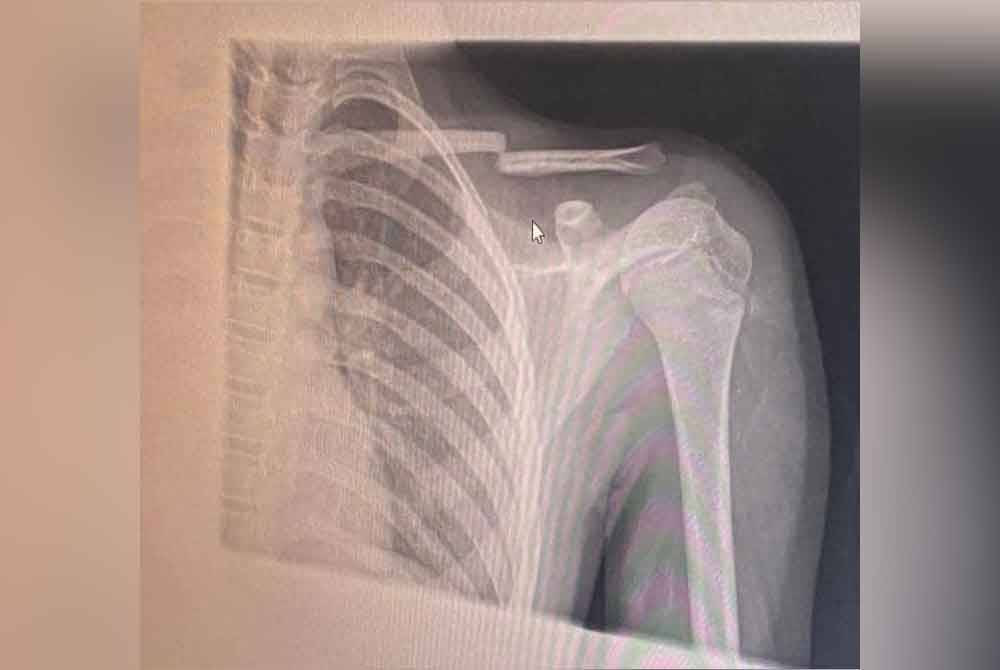 An X-ray image of the victim’s injury shared by his mother with Sinar.