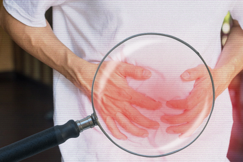 In 2019 alone, global data recorded 32.53 million cases of inguinal, femoral, and abdominal hernias, with 13.02 million new diagnoses, most affecting men between the ages of 50 and 69. - CANVA
