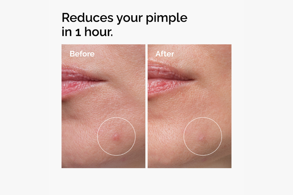 Testimony showing Sulfur 10% Powder-to-Cream Concentrate can reduce acne in just one-hour. - Photo: The Ordinary