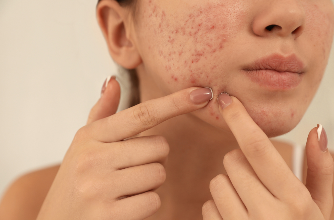 For many, the ‘pop’ feels like a quick fix, but dermatologists and scientists will tell you it is the fast track to scars, irritation and regret. Photo: Canva
