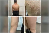 An initial examination of the victim’s body revealed marks suspected to be from physical abuse. Photo courtesy of police.