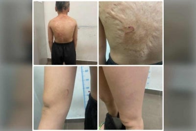 An initial examination of the victim’s body revealed marks suspected to be from physical abuse. Photo courtesy of police.