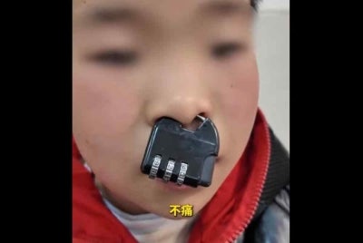 A picture of the padlock lodged in the young boy’s nose went viral on social media.