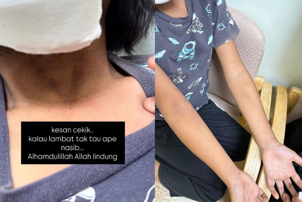 Fairoz said his daughter suffered minor injuries to her chin, lips and gums, swelling on the head and is experiencing trauma.