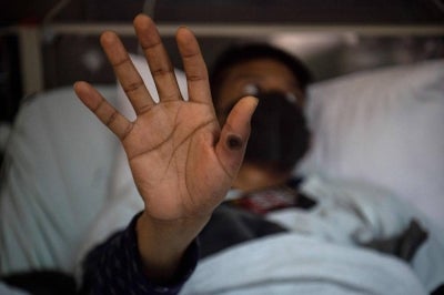 This file photo taken on August 16, 2022 shows a patient showing his hand with a sore caused by an infection of the monkeypox virus, in the isolation area for monkeypox patients at the Arzobispo Loayza hospital, in Lima, Peru. - AFP file photo