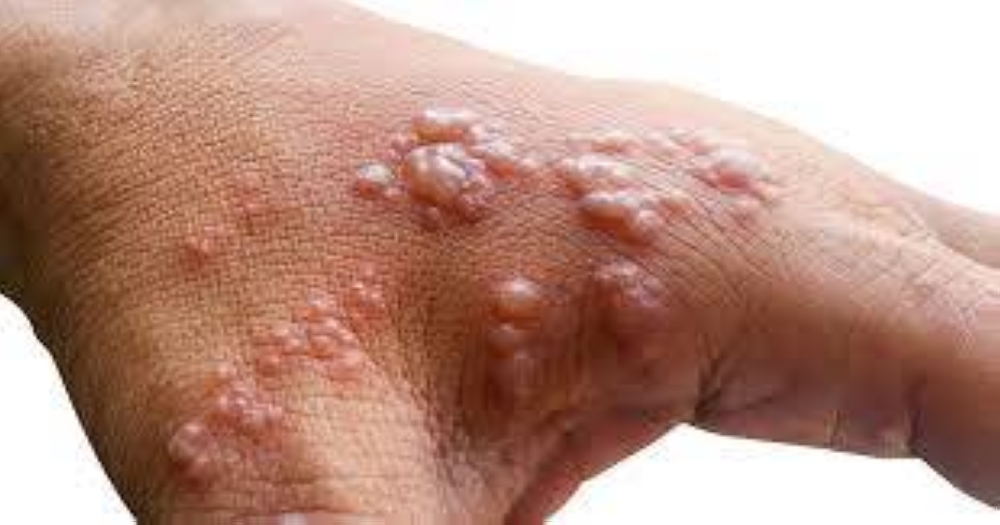 
Mpox boleh membawa maut dengan kadar kematian antara
tiga hingga lima peratus.