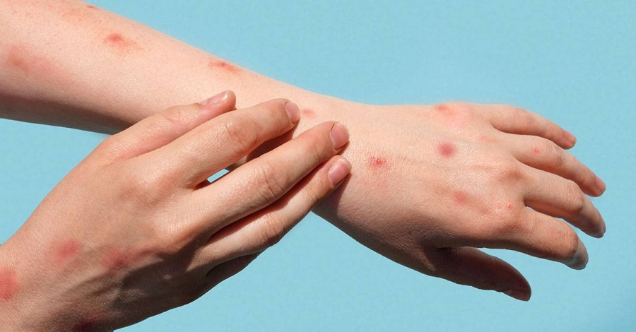 Kerajaan Pulau Pinang menafikan berlaku penularan penyakit mpox di negeri ini seperti yang ditularkan dalam media sosial baru-baru ini. (Gambar kecil: Daniel Gooi)