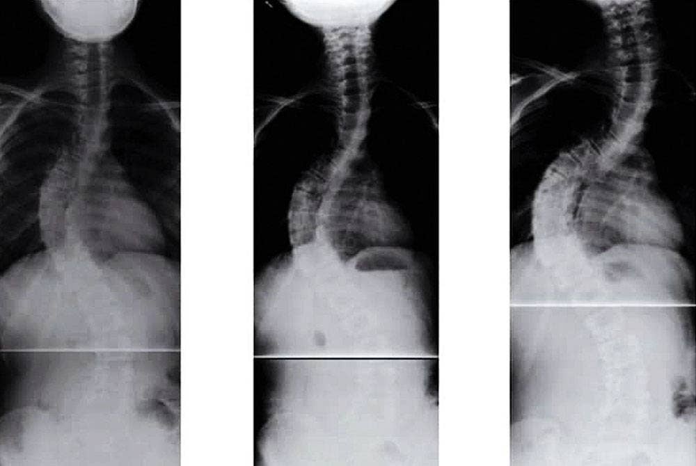 Gambar berikut menunjukkan perbandingan X-ray seorang pesakit 'Adolescent Idiophatic Scoliosis' yang lengkungan pada tulangnya semakin teruk dalam masa setahun sehingga memerlukan pembedahan segera.
