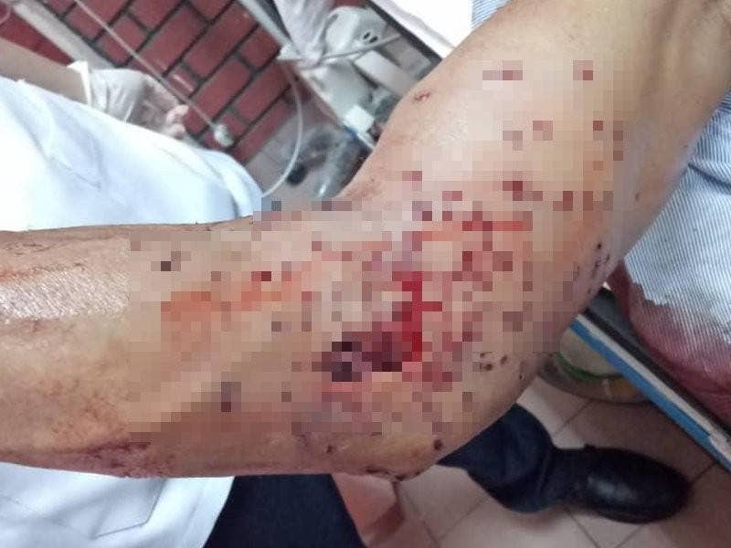 Keadaan lengan mangsa selepas terkena tembakan dari rakannya ketika membersihkan kebun.