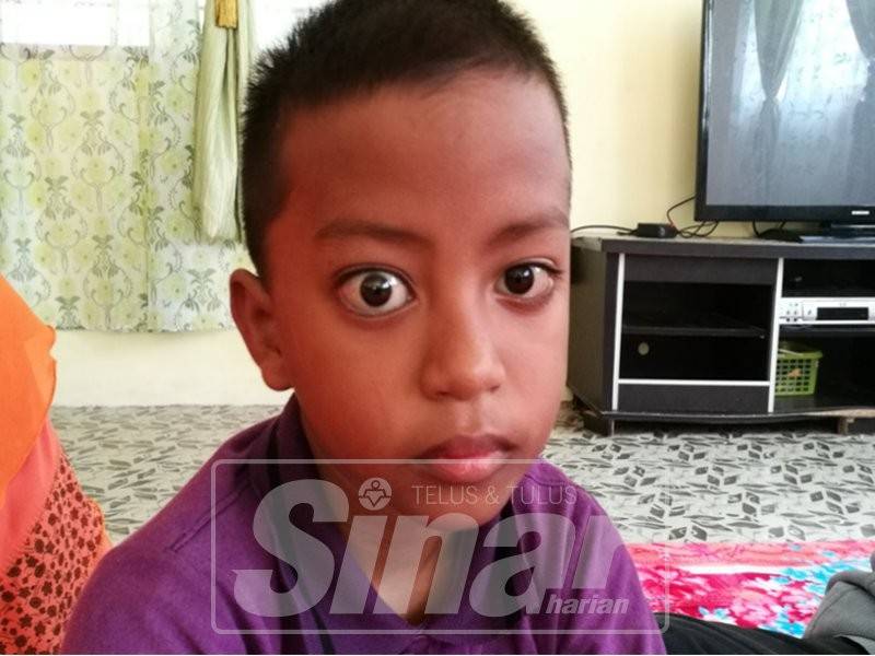 Mata kanan Syukri lebih besar dari mata kirinya. 