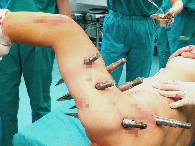 Badan Zhou ditusuk 10 batang besi tajam setelah dihempap sebuah mesin robotik yang mengalami kerosakan. - Foto Rex Feature