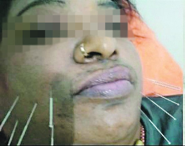 Akupunktur di wajah.