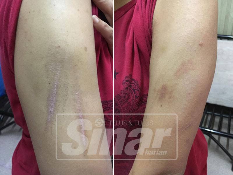 Kecederaan yang dialami mangsa.