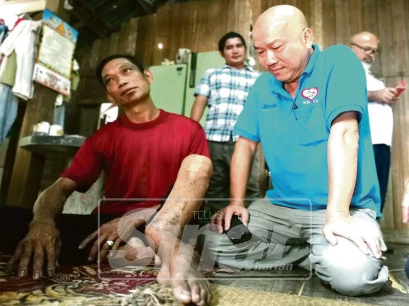 Tiong Lam melihat kaki Eh Fau yang bengkok akibat kemalangan lapan tahun lalu.
