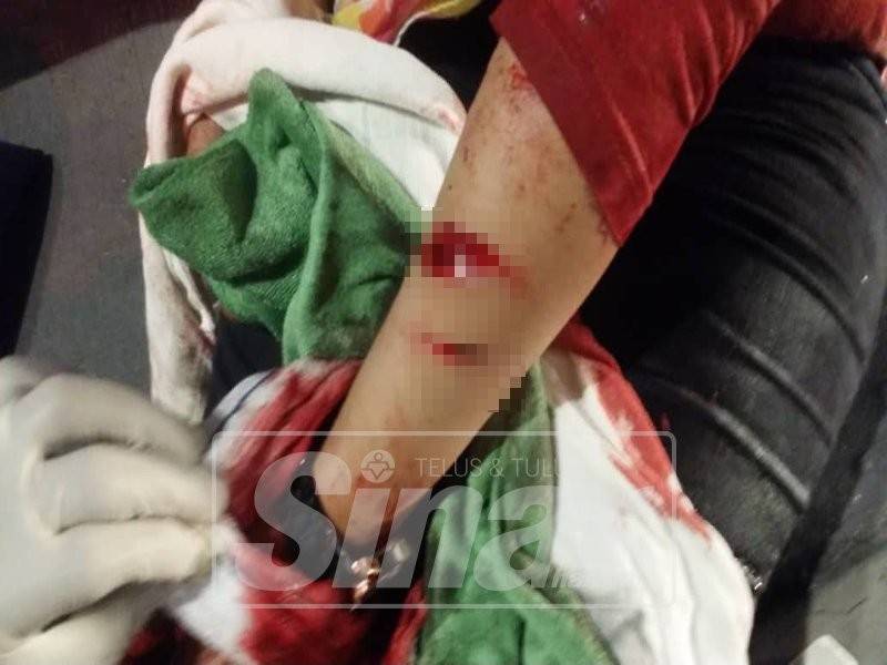 Kesan kecederaan di tangan mangsa.