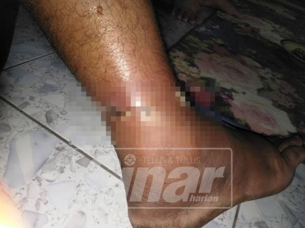 Kecederaan pada kaki Mohd Suhaimi akibat diserang beruk, baru-baru ini.
