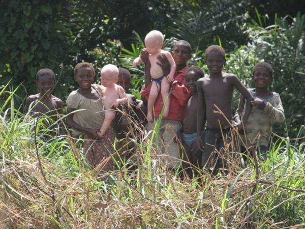 Kanak-kanak albino di Tanzania sering jadi sasaran pembunuhan ritual.