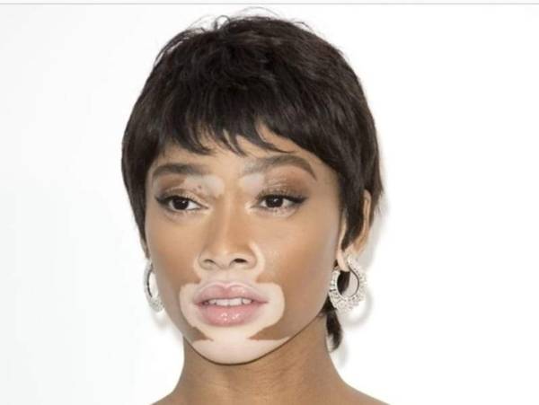 Ubat Penyakit Kulit Vitiligo - Bertanya e