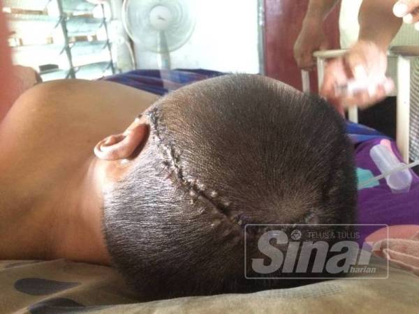 Keadaan tempurung kepala Muhammad Aizat yang terpaksa dibuang sebahagiannya akibat mengalami pendarahan akibat strok.