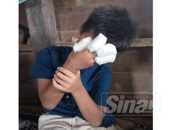 Muhammad Syukran menunjukkan empat jarinya yang terkena mercun.