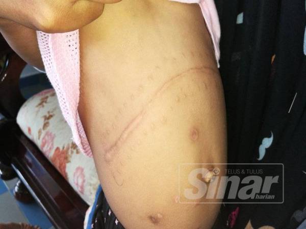 Kesan jahitan pembedahan pemindahan hati masih jelas kelihatan selepas setahun.
