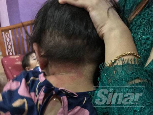 Kesan merah di tengkuk Aisyah yang masih kelihatan. 