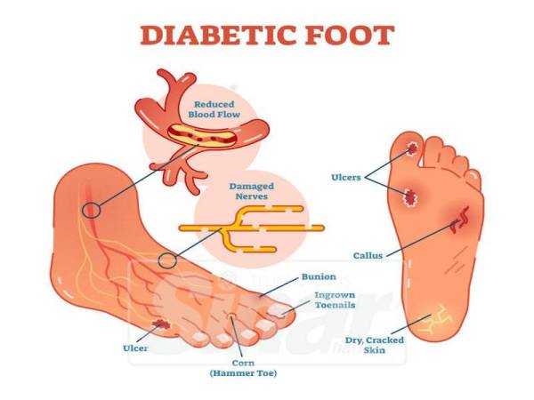Ciri-ciri kaki yang mempunyai tanda-tanda diabetis