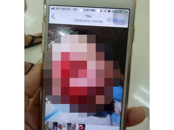 Kanak-kanak berusia 11 tahun cedera parah di muka selepas diserang anjing ketika bermain di rumah jirannya. - Foto ihsan pembaca