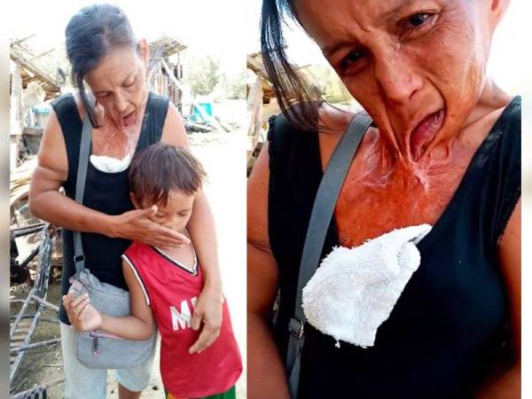 Parut pada wajah Leonor, kesan insiden kebakaran pada 2004. - Foto Mirror