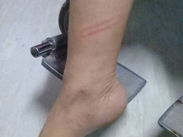 Mangsa mengalami kecederaan dan pendarahan kini dirawat di Hospital Umum Miri.