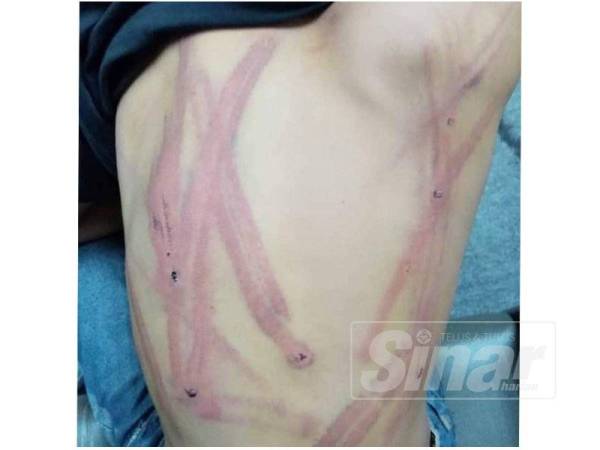 Mangsa mengalami calar di bahagian belakang dan beberapa bahagian badan dipercayai dipukul tiga lelaki menggunakan getah paip.