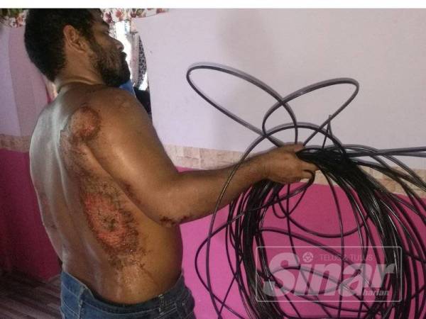 Baihaqi menunjukkan kecederaan dialami dan kabel yang dilanggarnya di Kampung Alor Menong pada Rabu lalu.